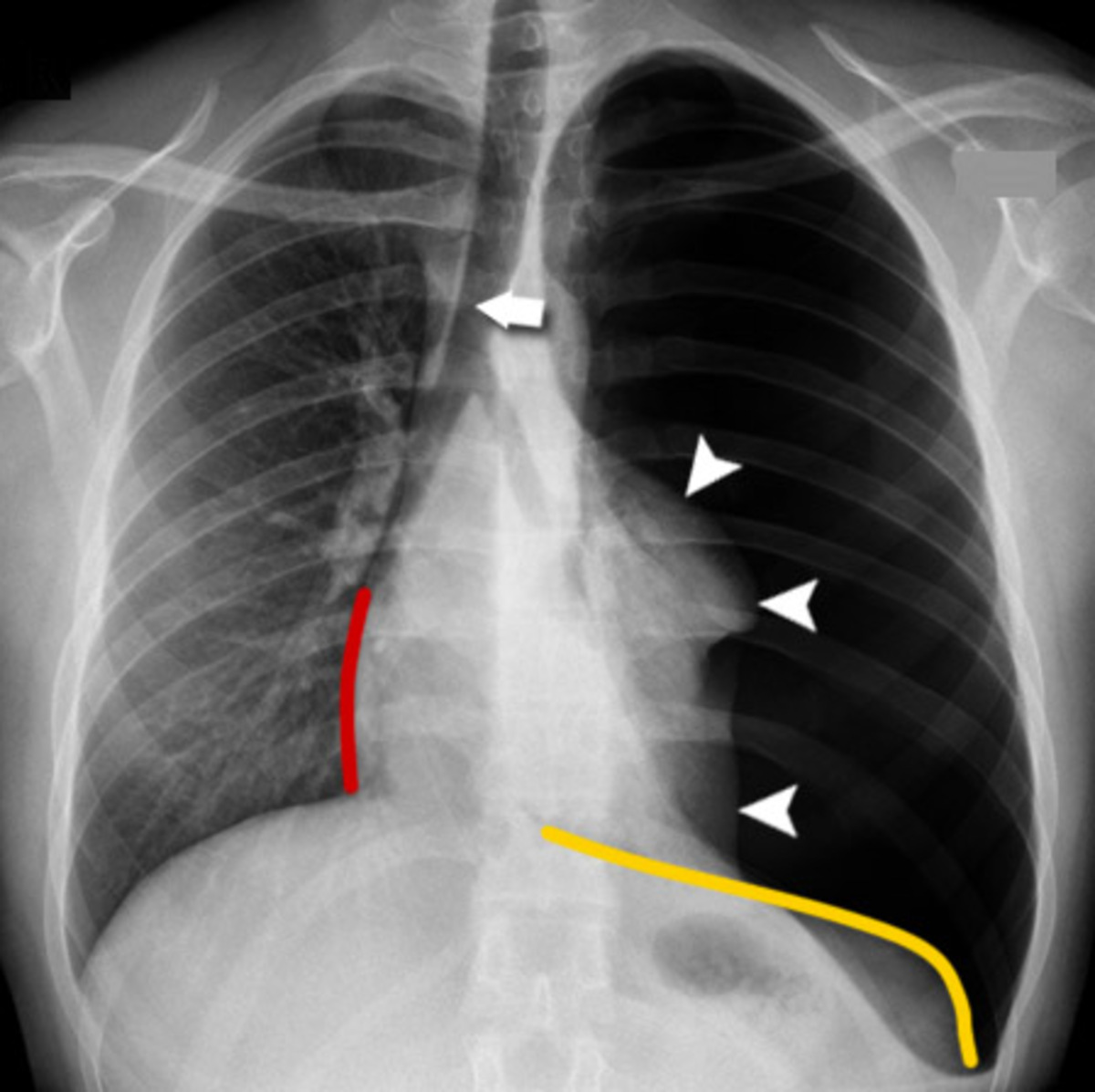 Pneumothorax Detector Model | Kaggle