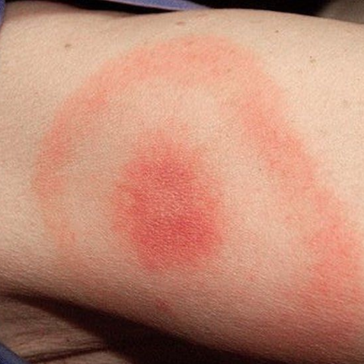 Lyme Disease Erythema Migrans Rashes Kaggle