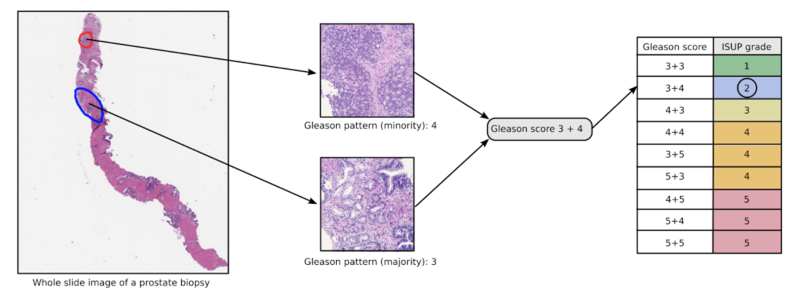 Illustration of the biopsy grading assigment