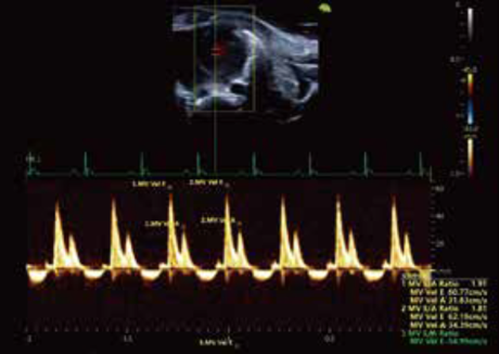 マウス僧帽弁血流スペクトル
