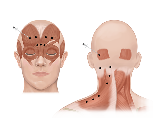 Botox injections for migrane diagram