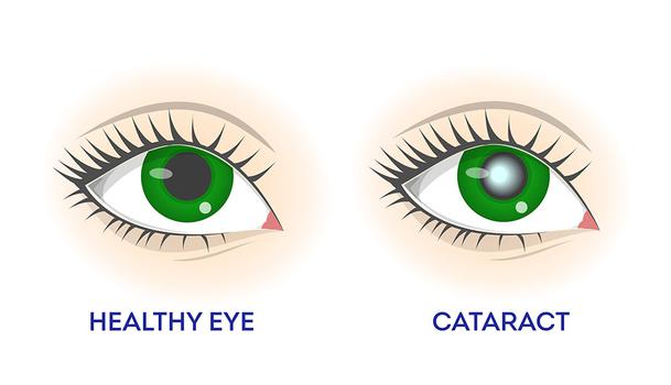 Healthy Eye vs Eye with Cataract 