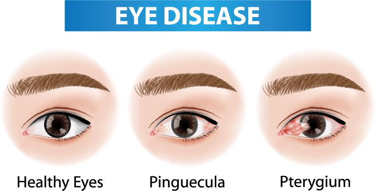 Comparison of Healthy Eye vs Pinguecula and Pterygium