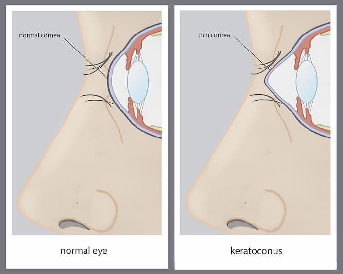 Normal Cornea vs Cornea with Keratocongus