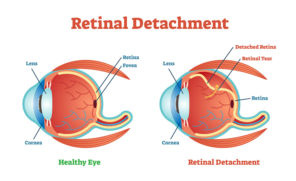 Healthy Retina vs Eye with Retinal Detachment