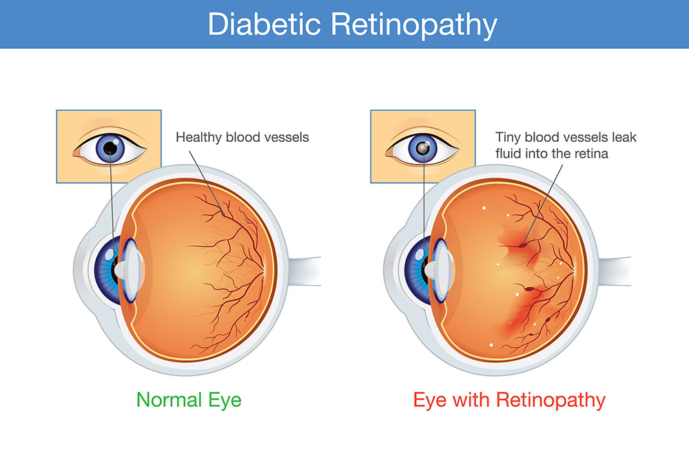 Normal Eye vs Eye with Retinopathy