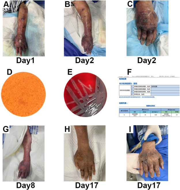 A case report of Vibrio vulnificus sepsis in a diabetic patient