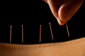 Acupuncture traditional Chinese medicine