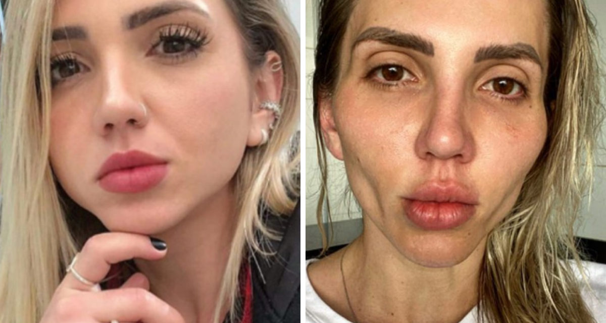 Influencer se destroza el rostro tras realizarse una bichectomia