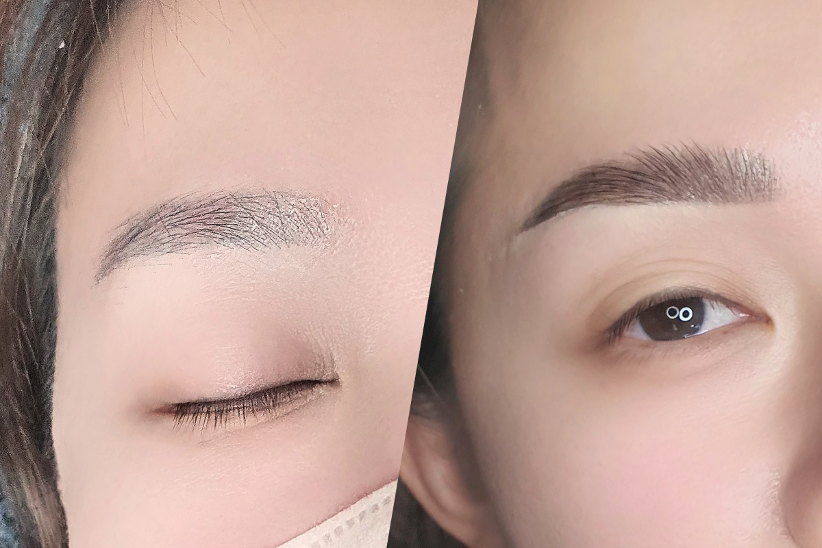 eyebrow-problems-brow-lifting-solves