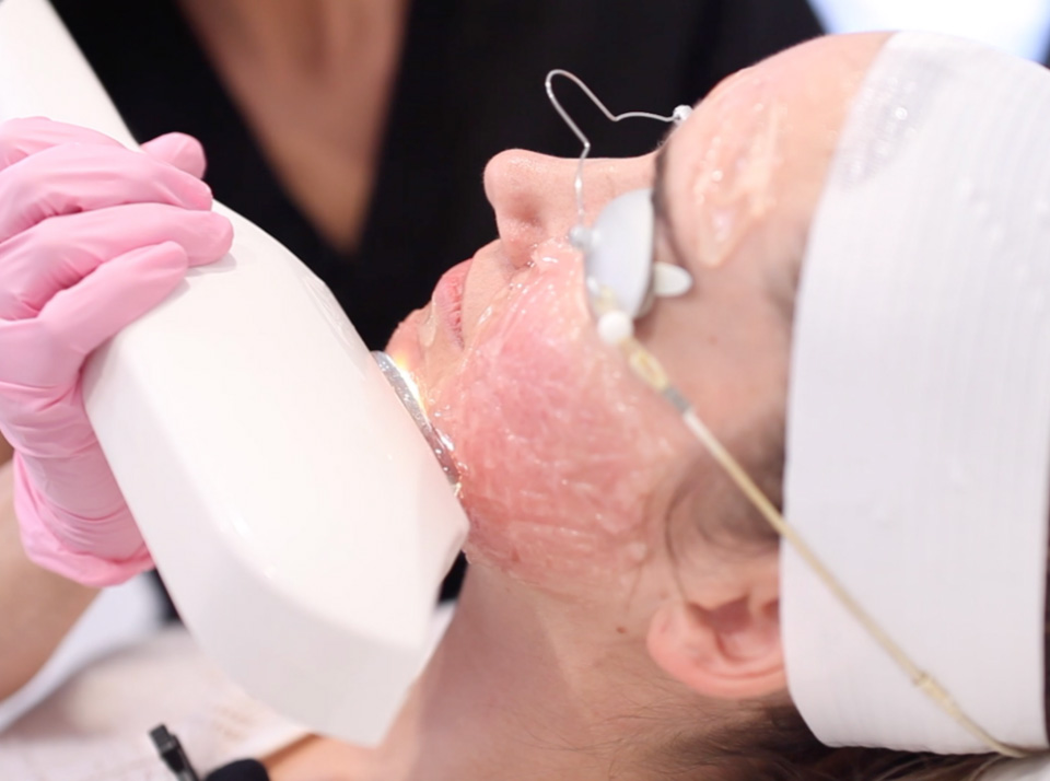 Image of Lady getting IPL Photofacial Treatment