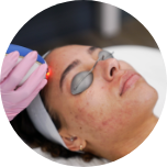 LaserAway service image for Acne Scar Removal