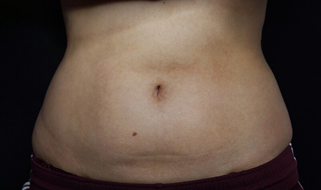 CoolSculpting for C Section Pouch - Reston Dermatology + Cosmetic Center