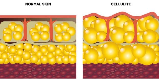 The Truth About Cellulite