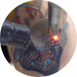 LaserAway service image for Laser Tattoo Removal