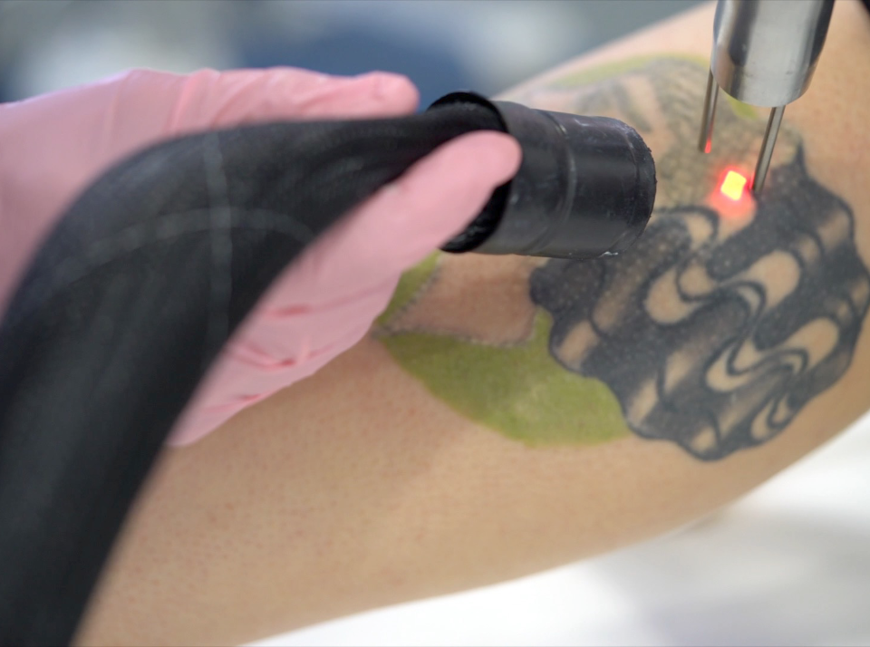 Tattoo Removal with PicoSure. - Tattoo Removal Central