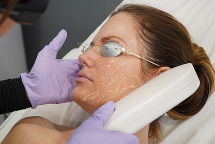 IPL Photo Facial