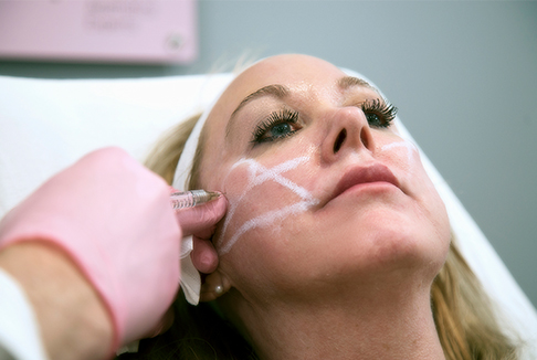 Dermal Fillers