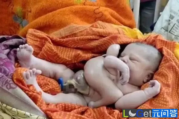 印度奇闻异事：4手4腿的婴儿居然不是双胞胎?