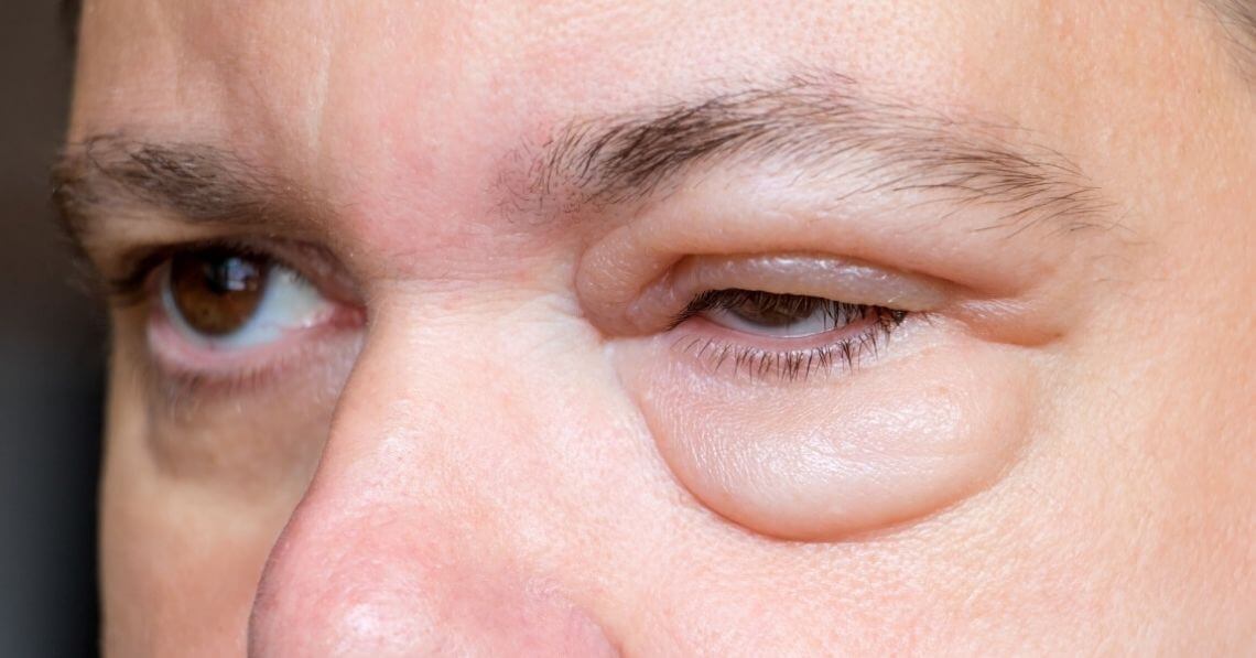 Swelling of the eye