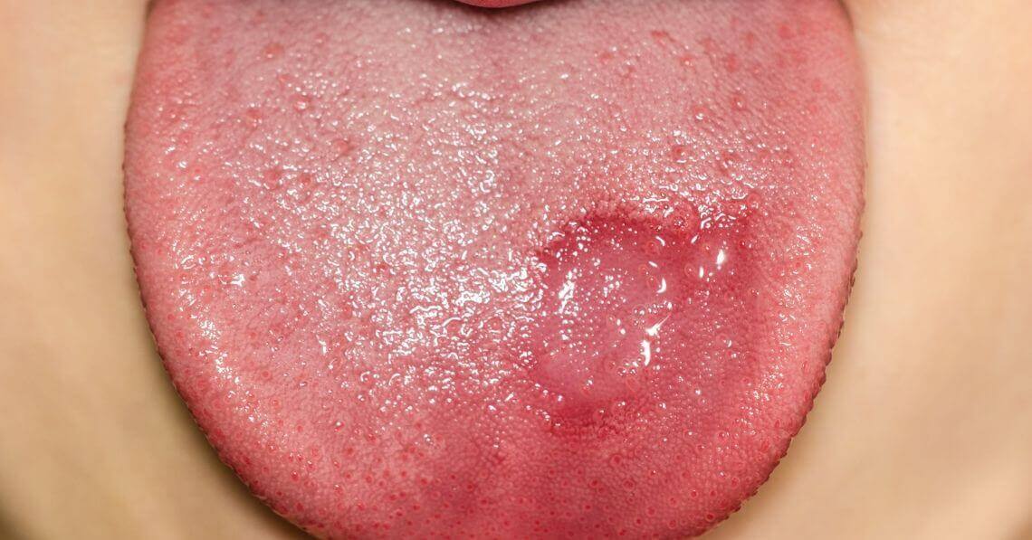 Bump on tongue