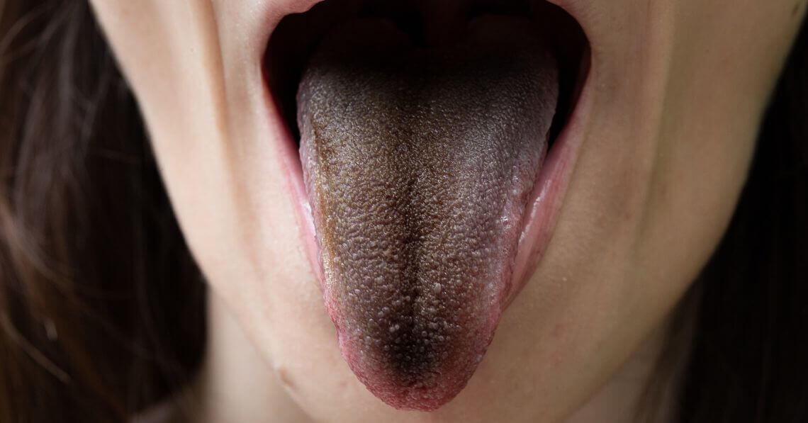 Black tongue