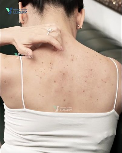 Phòng Khám Luxury - Điều Trị Viêm Nang Lông Công Nghệ Cao