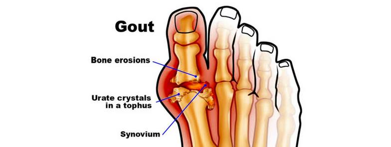 The Truth About Gout