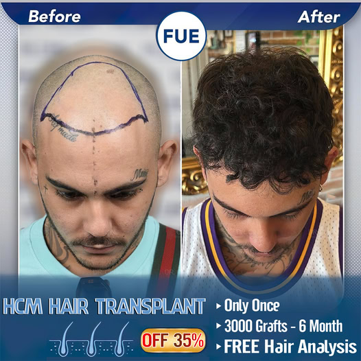 Hcm Hair Transplant Institute