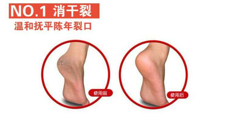 Foot healthcare, foot problem, dry and cracking foot. Function socks