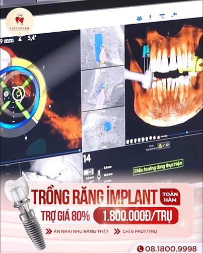 Viện Cấy Ghép Răng implant - Lava Dental