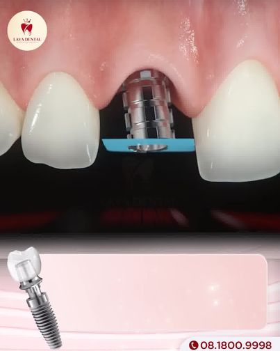 Viện Cấy Ghép Răng implant - Lava Dental