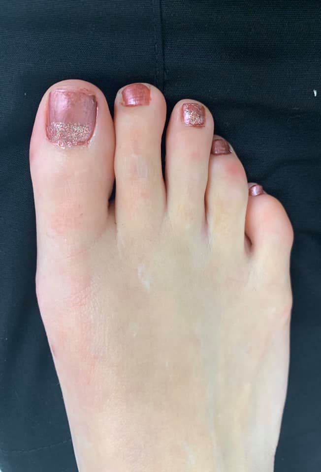 Minimally invasive bunion surgery - have questions? Get Answers!