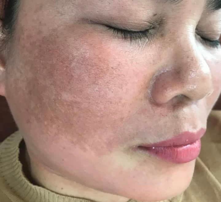 HỘI NHỮNG NGƯỜI BỊ MỤN, NÁM, TÀN NHANG