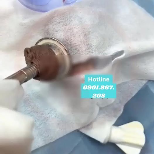 Cắt Bao Quy Đầu Thẩm Mỹ