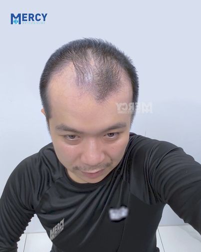 Dr.Vũ Phương Anh - Điều Trị Rụng Tóc Hói Đầu Chuẩn Y Khoa