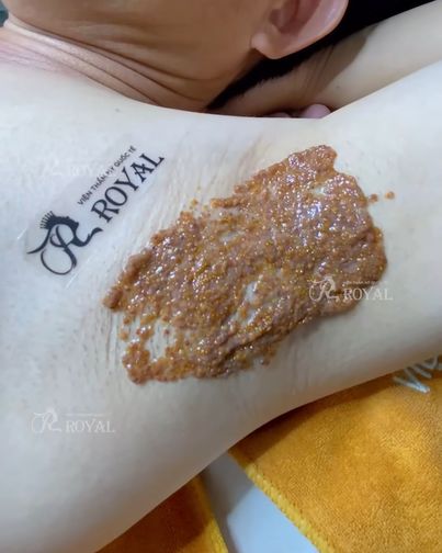 Đặc trị hôi nách vĩnh viễn - Viện da liễu Royal Sài Gòn