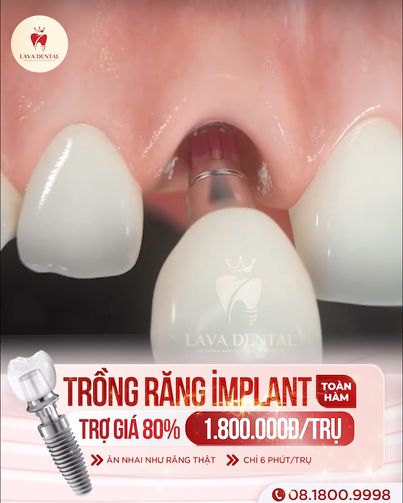 Viện Cấy Ghép Răng implant - Lava Dental