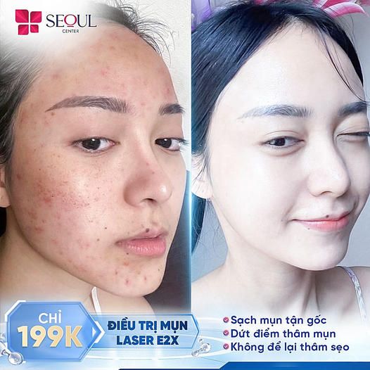 Collagen Trẻ Hóa HA - Không Phẫu