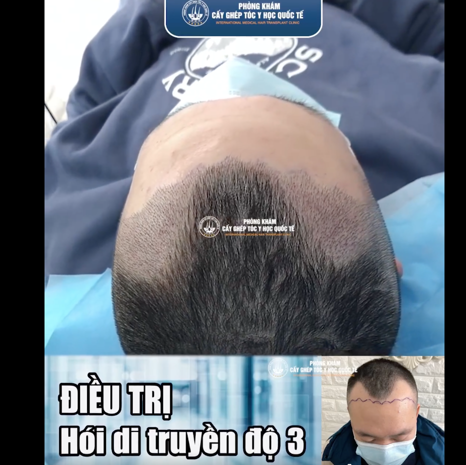 Phòng Khám Cấy Tóc Y Học Quốc Tế HCM