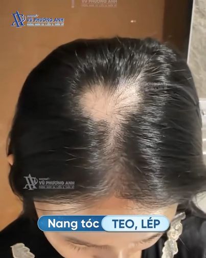 BS Vũ Phương Anh - Điều Trị Hói Đầu, Rụng Tóc