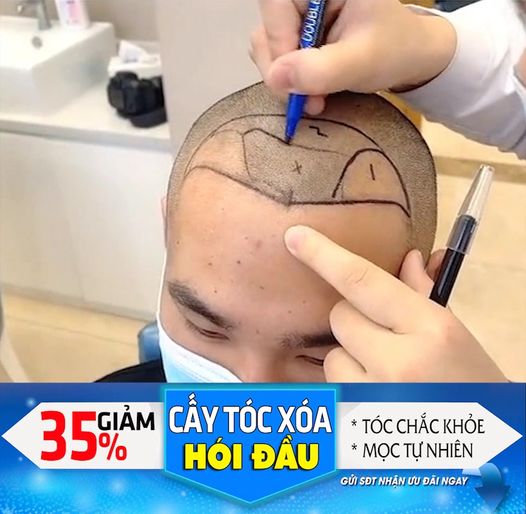 Trung Tâm Điều Trị Rụng Tóc & Hói Đầu