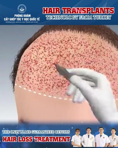 Hair Transplant Vietnam - Technology from Turkey