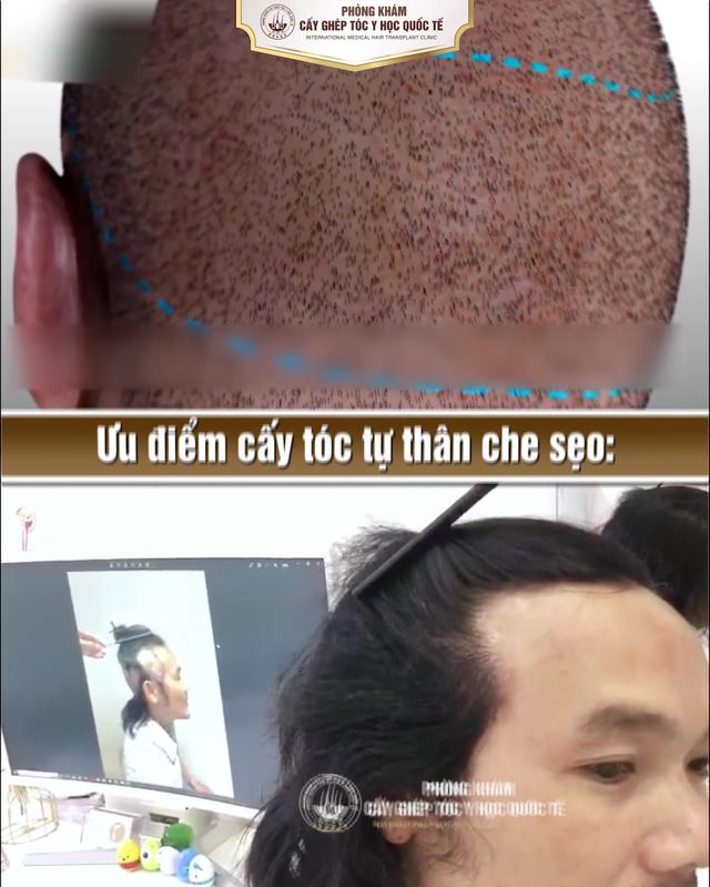 Viện Cấy Tóc - Cấy Râu - Cấy Lông Mày HCM