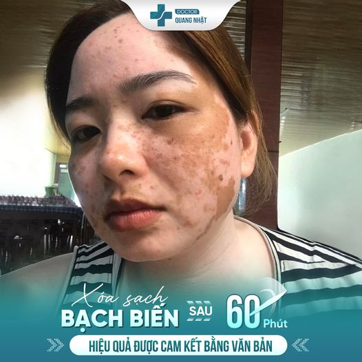 Viện Điều Trị Bạch Biến Công Nghệ Cao - Viện Da Liễu Sài Gòn 