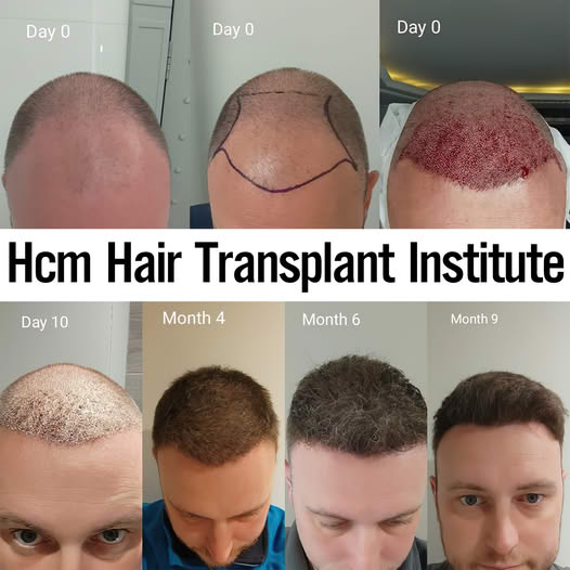 Hcm Hair Transplant Institute