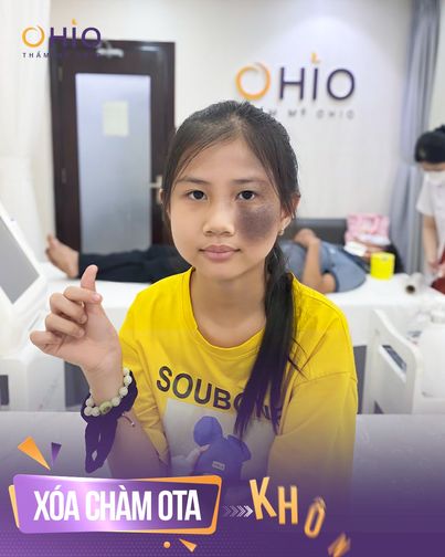 Chuyên Khoa Xóa Chàm Bớt, Sắc Tố - OHIO Sài Gòn
