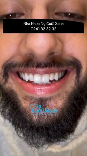 Nha Khoa Nụ Cười Xanh - Chuyên Dán Veneer Sứ Không Mài Nhỏ Răng