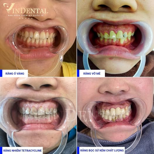 Nha Khoa Quốc Tế Vindental HCM