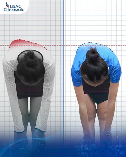 USAC Chiropractic - Viện điều trị cong vẹo cột sống, gù lưng chuẩn Mỹ